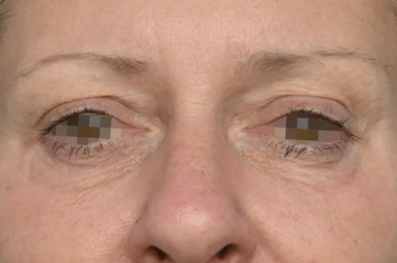 หลังทำ EMFACE — บริเวณรอบดวงตา