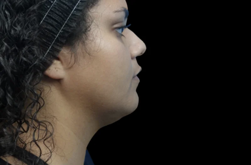 หลังทำ EMFACE — มุมข้างกรามและใต้คาง