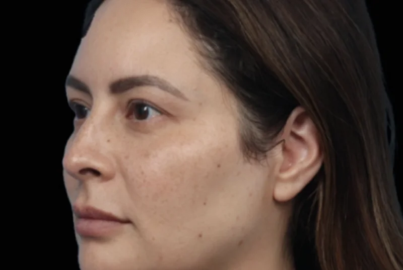 หลังทำ EMFACE — มุมเฉียงแก้มและกราม