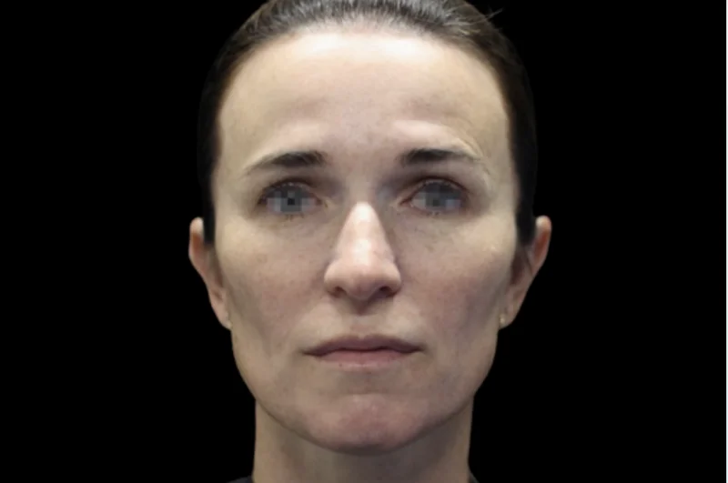 หลังทำ EMFACE