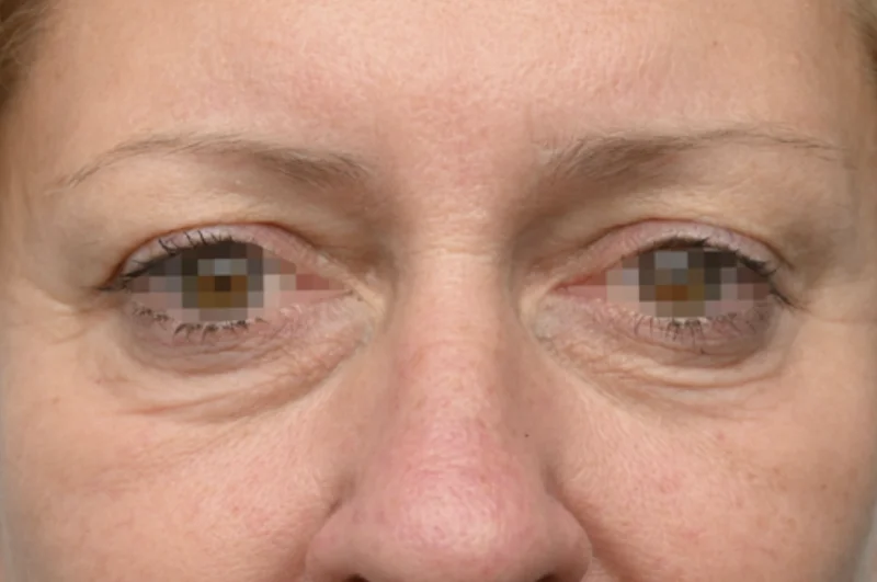 ก่อนทำ EMFACE — บริเวณรอบดวงตา