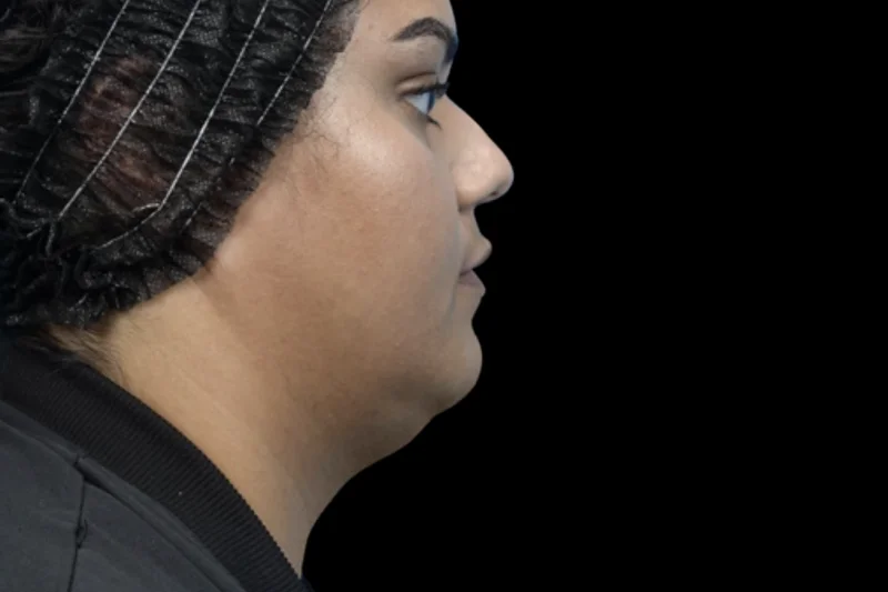 ก่อนทำ EMFACE — มุมข้างกรามและใต้คาง