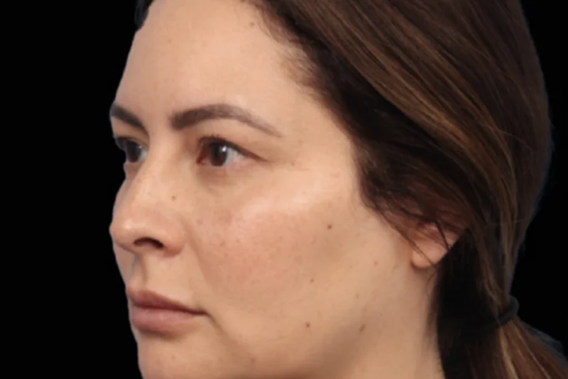 ก่อนทำ EMFACE — มุมเฉียงแก้มและกราม