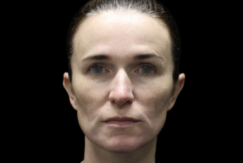 ก่อนทำ EMFACE