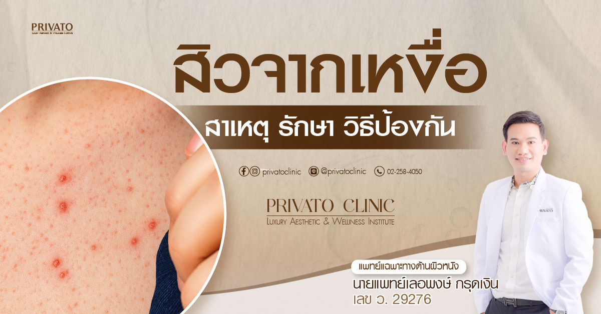 สิวจากเหงื่อ