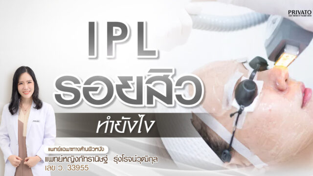IPL-รอยสิว