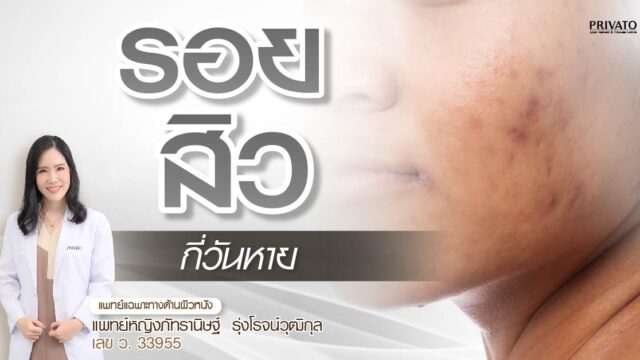 รอยสิวกี่วันหาย? รวมวิธีรักษารอยดำ รอยแดงจากสิวให้จางเร็ว