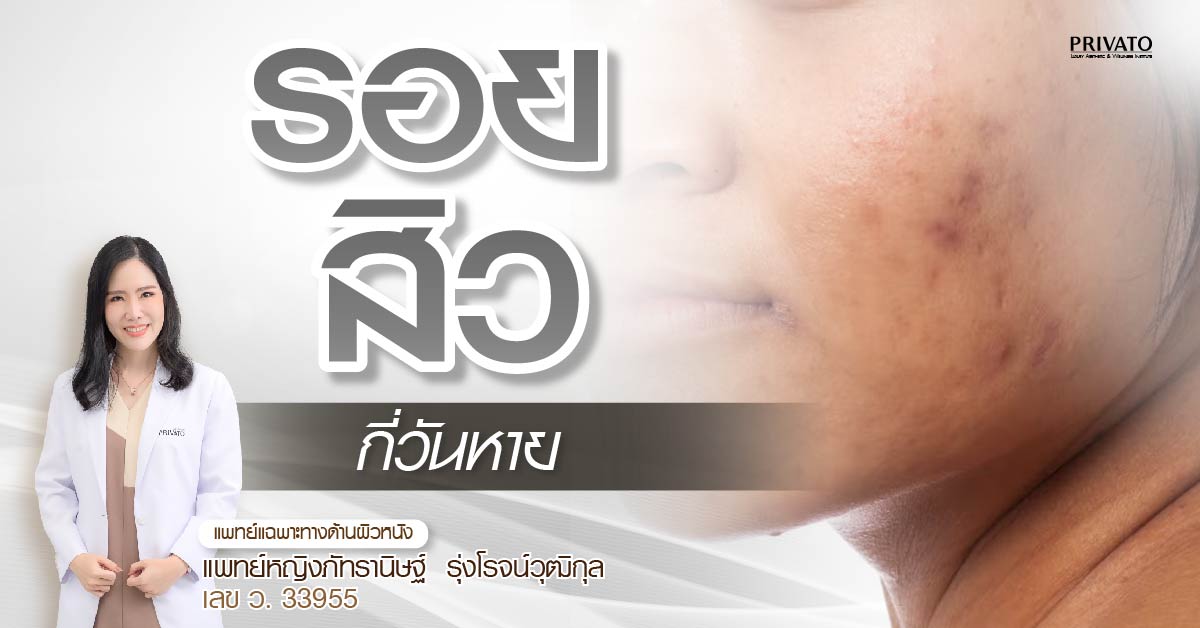 รอยสิวกี่วันหาย? รวมวิธีรักษารอยดำ รอยแดงจากสิวให้จางเร็ว