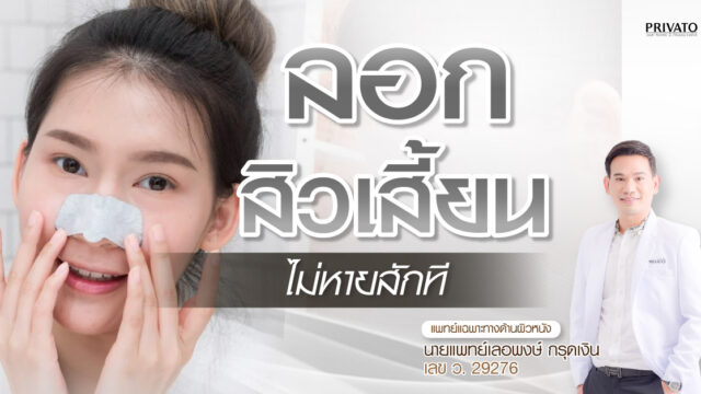 ลอกสิวเสี้ยน อย่างถูกต้องทำยังไง