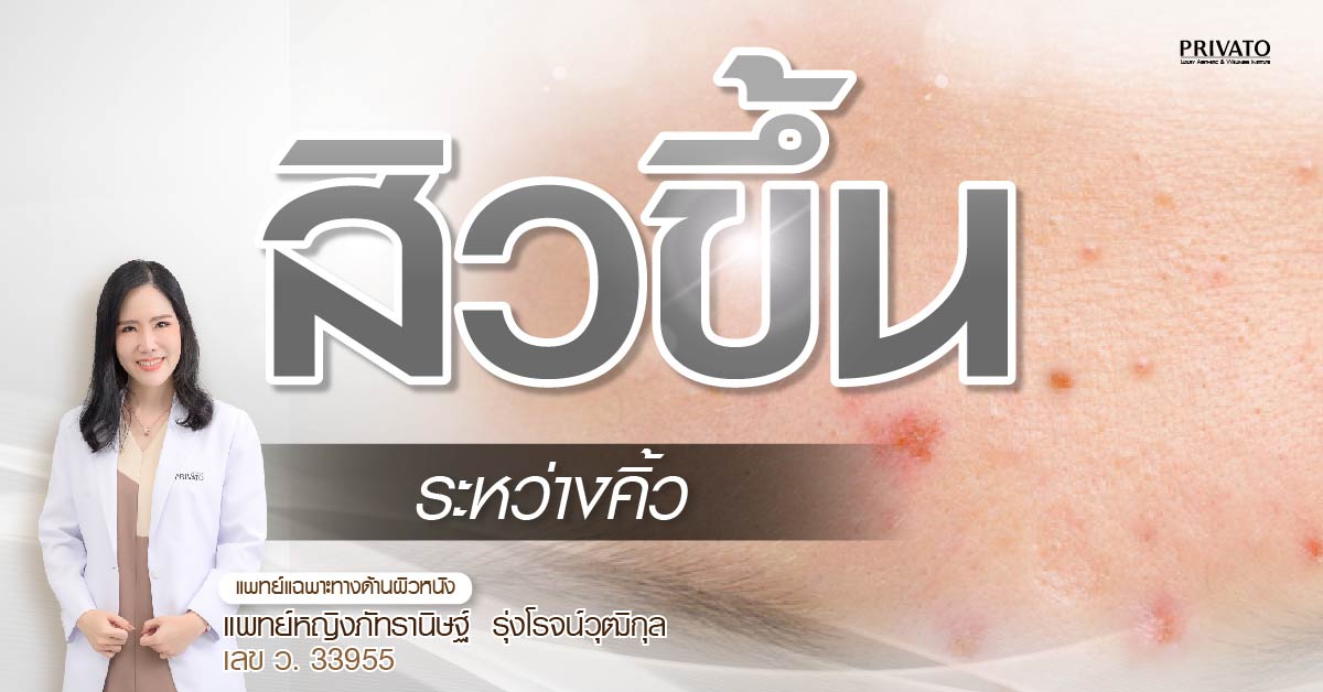 สิวขึ้นระหว่างคิ้ว