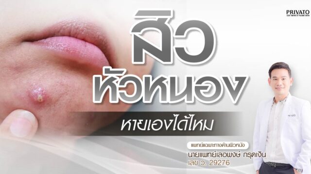 สิวหัวหนองหายเองได้ไหม กี่วันหาย และควรเริ่มรักษาเมื่อไร