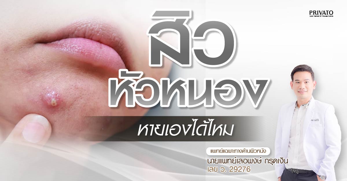 สิวหัวหนองหายเองได้ไหม กี่วันหาย และควรเริ่มรักษาเมื่อไร