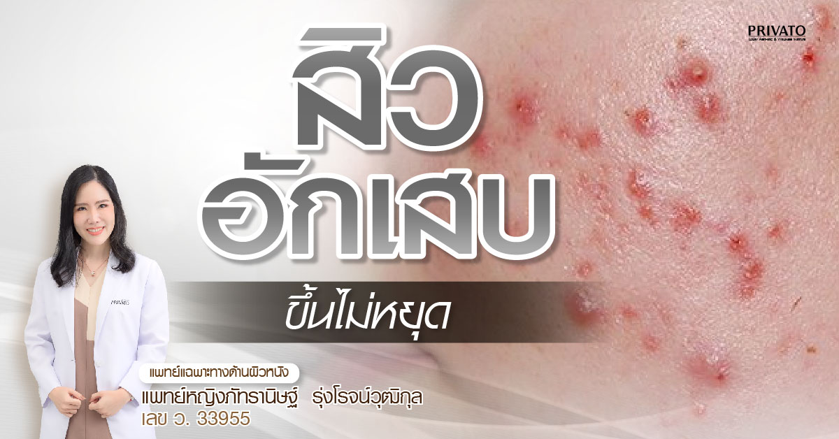 สิวอักเสบขึ้นไม่หยุด ต้องทำอย่างไร