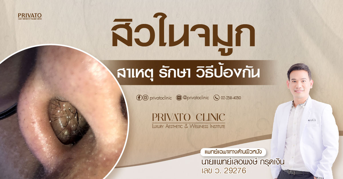 สิวในจมูก วิธีดูแลตัวเองขั้นพื้นฐาน ลดเสี่ยงกำเริบ