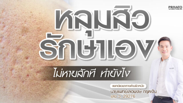 หลุมสิวรักษาเองได้หรือไม่