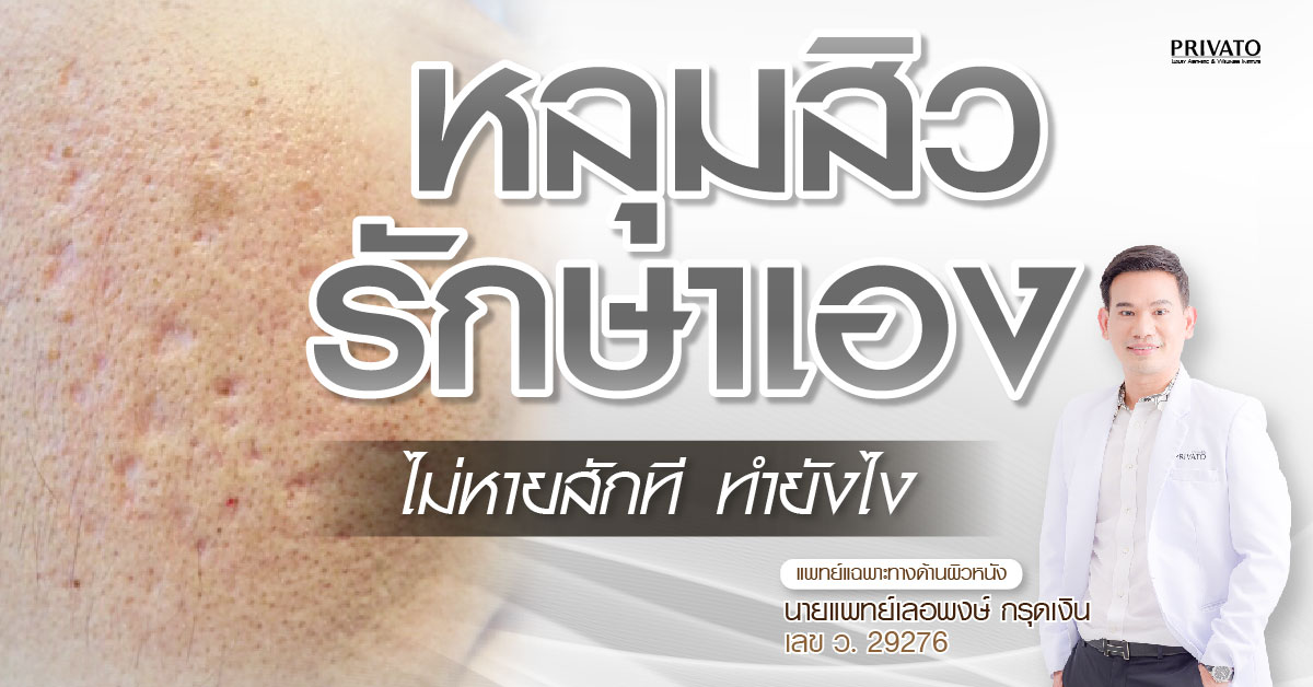 หลุมสิวรักษาเองได้หรือไม่