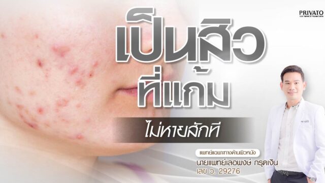 สิวที่แก้มไม่หายสักที เกิดจากอะไร รักษาอย่างไรดี