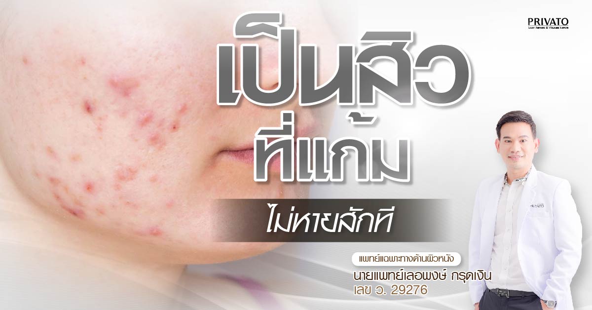 สิวที่แก้มไม่หายสักที เกิดจากอะไร รักษาอย่างไรดี
