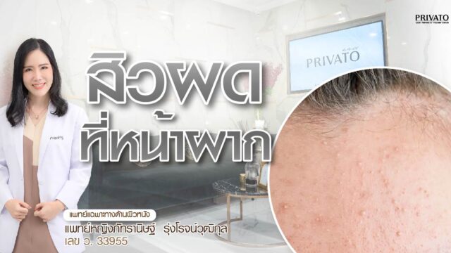 สิวผดที่หน้าผากเกิดจากอะไร? พร้อมวิธีรักษาและป้องกันอย่างถูกวิธี