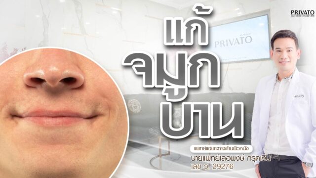 แก้จมูกบาน วิธีไหนดี? เปรียบเทียบชัดๆ ระหว่างศัลยกรรม vs ไม่ศัลยกรรม