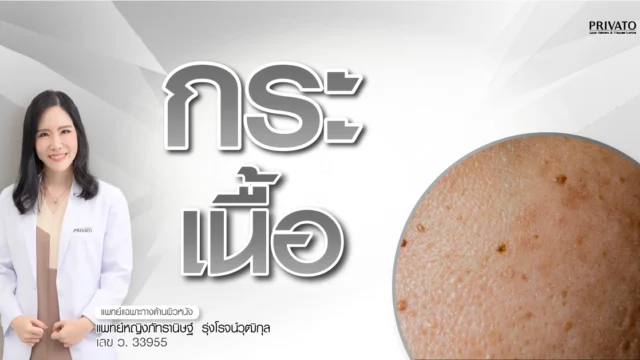 กระเนื้อ คืออะไร เกิดจากอะไร วิธีรักษาและป้องกัน