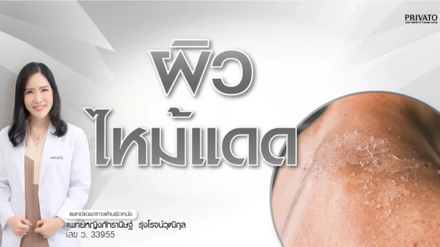 7 วิธีแก้ผิวไหม้แดดเร่งด่วน ลดอาการแสบแดง-ผิวลอก อัปเดต 2568