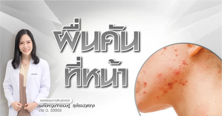 ผื่นคันที่หน้า สาเหตุ อาการ และวิธีรักษาให้หายขาด