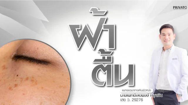 ฝ้าตื้นคืออะไร รักษาอย่างไรให้หายขาด? เจาะลึกสาเหตุและวิธีรักษาที่ดีที่สุด