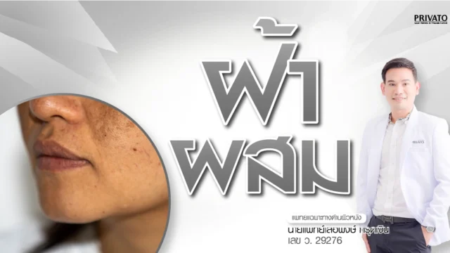 ฝ้าผสม คืออะไร? สาเหตุ อาการ และวิธีรักษาให้หน้ากลับมาใส