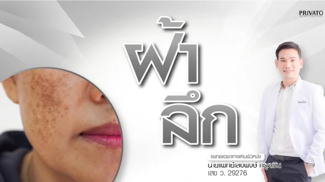 ฝ้าลึก รักษาอย่างไร? รวมวิธีดูแลและสาเหตุที่คุณควรรู้