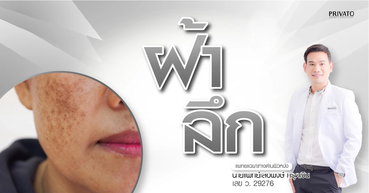 ฝ้าลึก รักษาอย่างไร? รวมวิธีดูแลและสาเหตุที่คุณควรรู้