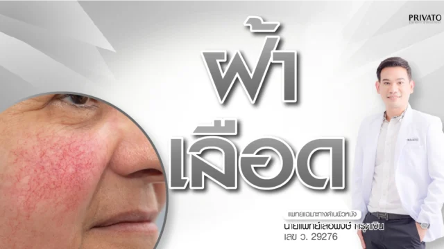 ฝ้าเลือดคืออะไร สาเหตุและวิธีรักษา