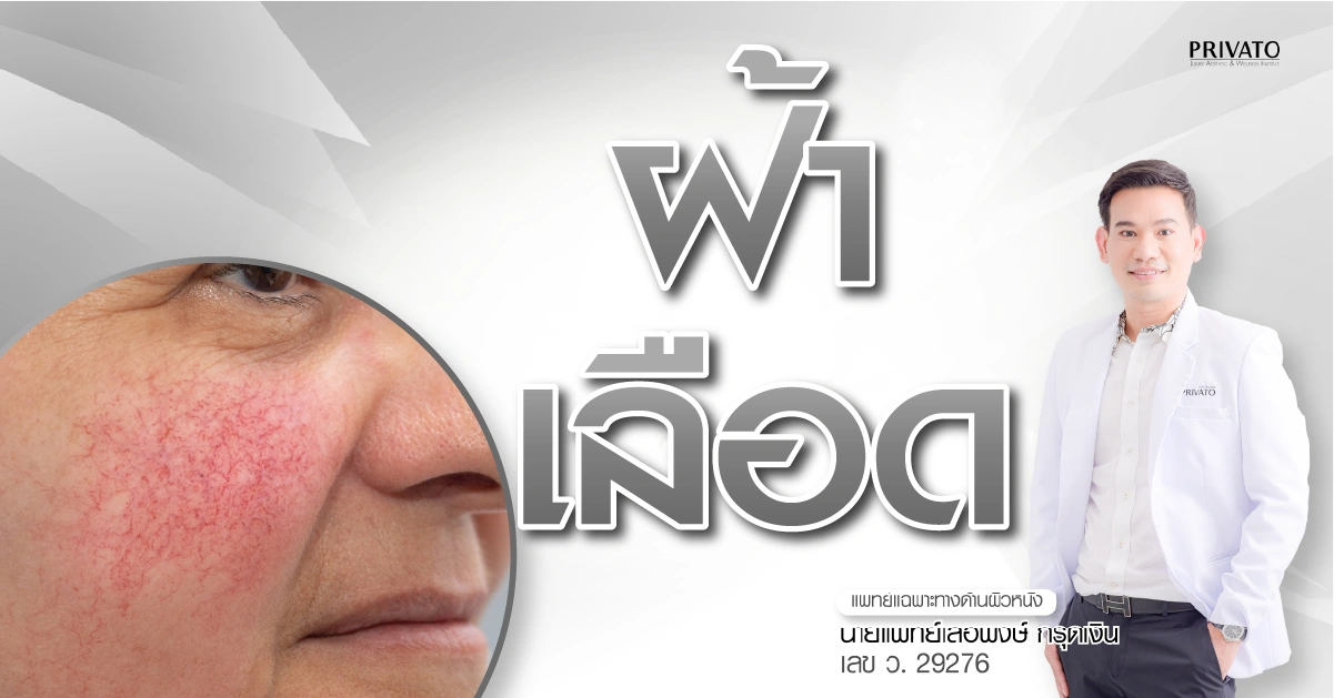 ฝ้าเลือดคืออะไร สาเหตุและวิธีรักษา