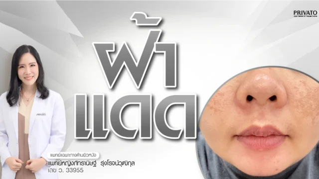 ฝ้าแดด คืออะไร สาเหตุ ลักษณะอาการ และวิธีรักษาให้หายขาด