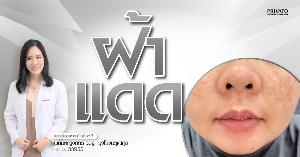 ฝ้าแดด คืออะไร สาเหตุ ลักษณะอาการ และวิธีรักษาให้หายขาด