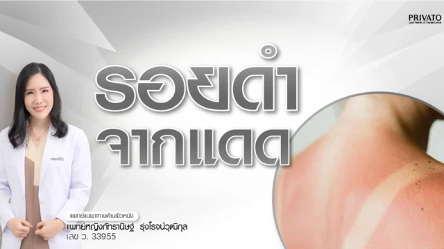 ผิวดำแดดกี่วันหาย? รวมวิธีฟื้นฟูรอยคล้ำจากแดดให้กลับมาขาวใส