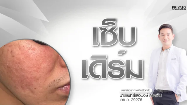 เซ็บเดิร์ม (Seborrheic Dermatitis) คืออะไร สาเหตุ อาการ และวิธีรักษา