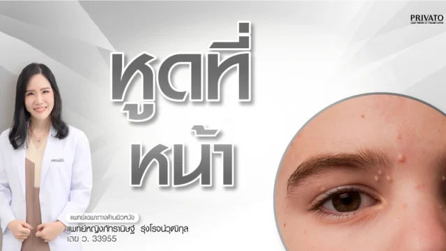 หูดที่หน้า: สาเหตุและวิธีรักษาให้หายขาดด้วยเลเซอร์