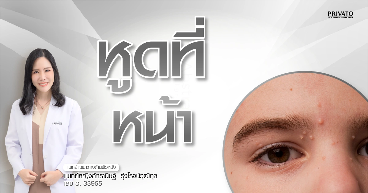 หูดที่หน้า: สาเหตุและวิธีรักษาให้หายขาดด้วยเลเซอร์