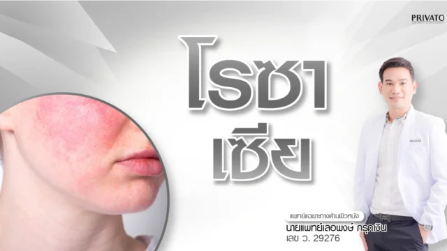 โรคโรซาเซีย (Rosacea) คืออะไร: อาการ สาเหตุ และวิธีรักษา