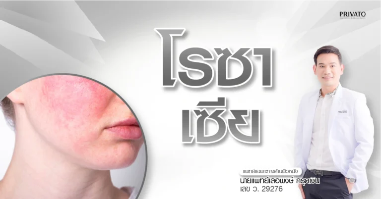 โรคโรซาเซีย (Rosacea) คืออะไร: อาการ สาเหตุ และวิธีรักษา