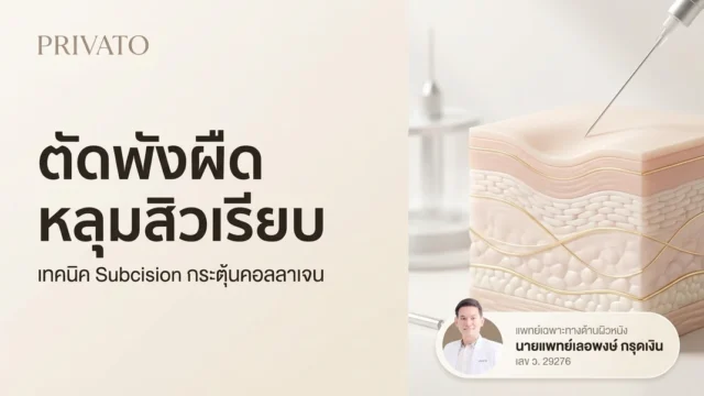 ตัดพังผืดหลุมสิว (Subcision) คืออะไร ช่วยรักษาหลุมสิวให้เรียบเนียนได้จริงไหม