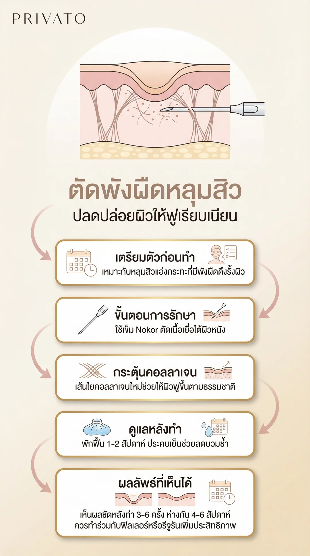 ตัดพังผืดหลุมสิว (Subcision) คืออะไร ช่วยรักษาหลุมสิวให้เรียบเนียนได้จริงไหม Infographic