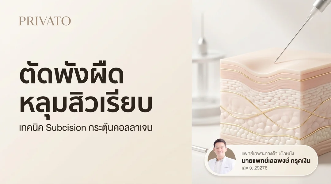 ตัดพังผืดหลุมสิว (Subcision) คืออะไร ช่วยรักษาหลุมสิวให้เรียบเนียนได้จริงไหม