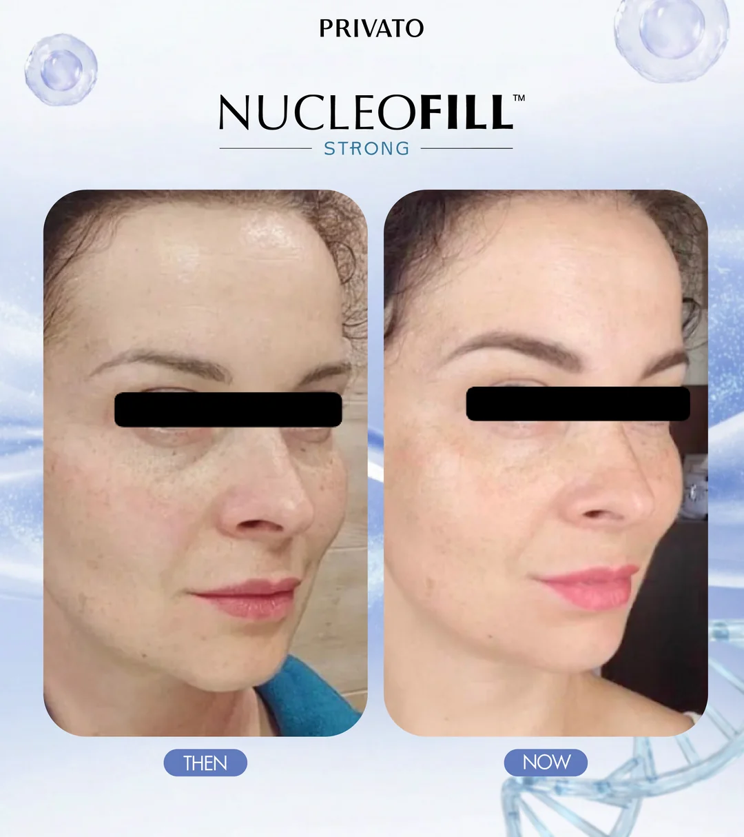 ก่อนและหลังใช้ Nucleofill Strong