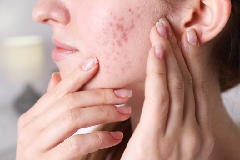 ตอบชัด !  IPL กับ Pico Laser แก้รอยดำ ต่างกันอย่างไร ?