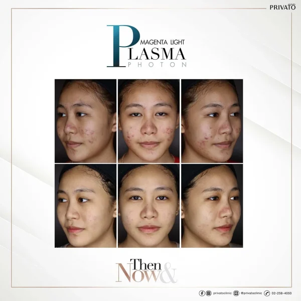 ภาพก่อน-หลังการรักษาสิวด้วย Plasma Photon