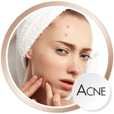 Acne