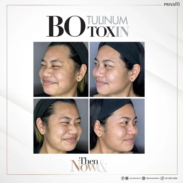 ผลลัพธ์โบท็อกซ์ตีนกา