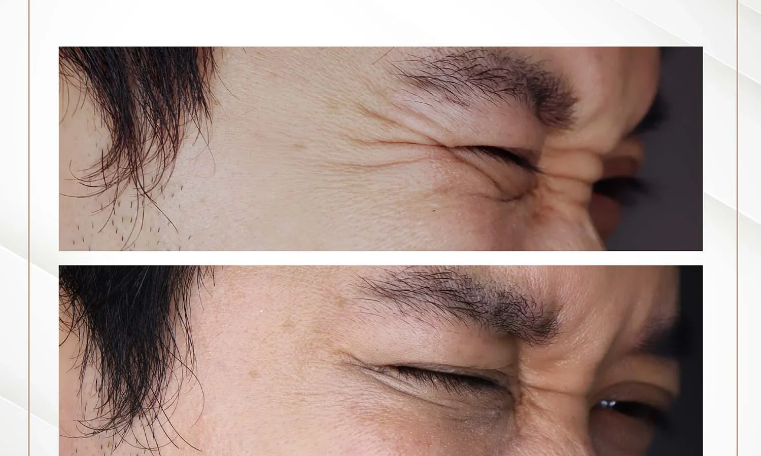 ภาพก่อน-หลังการรักษาตีนกาด้วยโบท็อกซ์